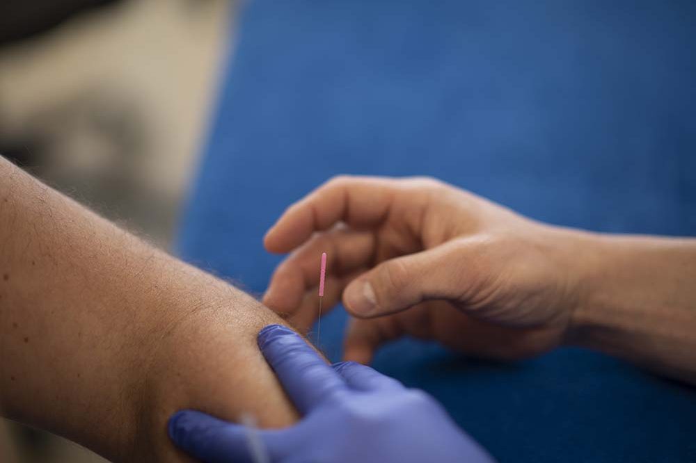 acupunctuur dry needling fysiotherapeut Groningen