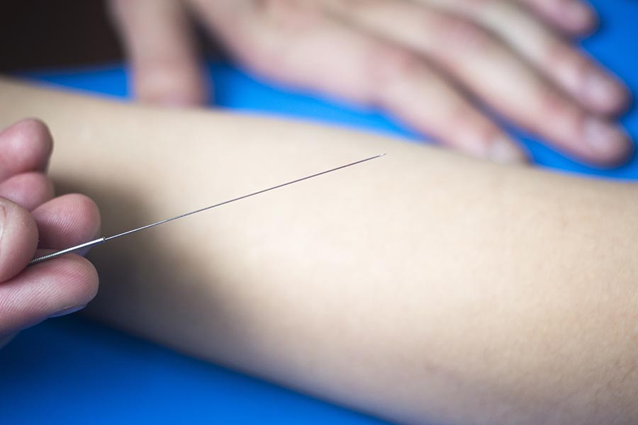 Dry Needling fysio Groningen